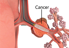 Airway Stents and Valves