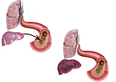 Alpha One Anti Trypsin Deficiency