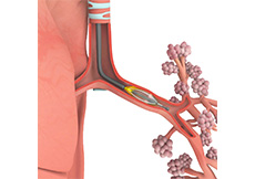 Bronchial Thermoplasty