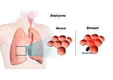 Emphysema