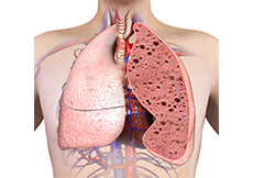 Interstitial Lung Disease