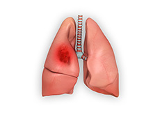 Lung Mass/Lung Cancer