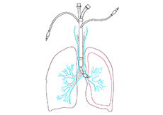 Lung Lavage