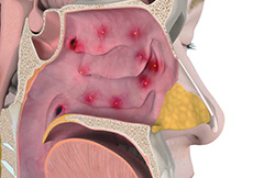 Management of Allergies