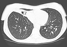 Mycobacterium Avium Infection