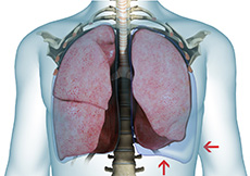 Pleural Effusions