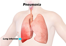 Pneumonia