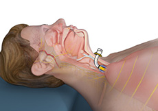 Tracheostomy