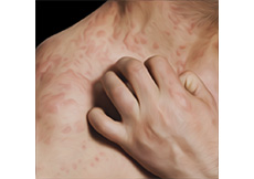 Urticaria and Angioedema